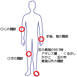 痛風の好発部位：足の親指の付け根・アキレス腱・くるぶし・かかと・足の甲・親指以外の関節・ひじの関節・手首・指の関節・ひざの関節