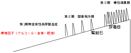 環境因子（アルコール・食事・肥満）・第1期　無症候性高尿酸血症・第2期　間歇発作期・第3期　慢性痛風期