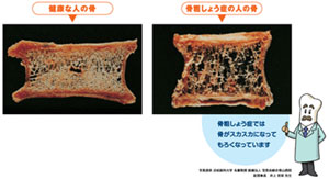 健康な骨は、網目状構造の“骨梁”がびっしりと詰まっていますが、骨粗しょう症の人の骨は、この骨梁が細くなったり折れてしまっている為にスカスカの骨になっています